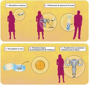 Fecondation-in-vitro-schema v2.jpg