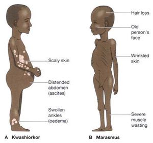 Malnutrition-soniaf4.jpg